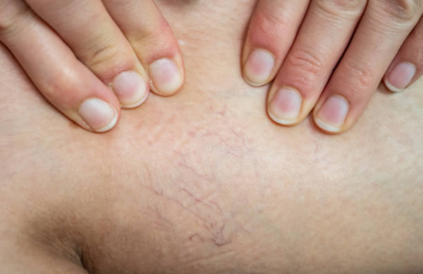 Varizes: Vencendo a Batalha Contra as Veias Dilatadas com Laser, Escleroterapia e Cirurgia