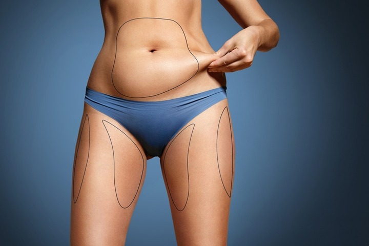 Lipoaspiração: Elimine a Gordura Localizada e Modele Seu Corpo!